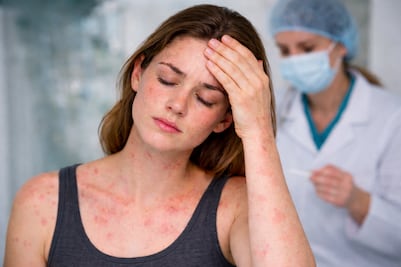 ¿Qué es el sarampión atípico? Señales que lo distinguen y a quiénes afecta este 2026