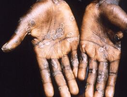 Viruela del mono. EU distribuirá vacunas entre contactos de personas infectadas