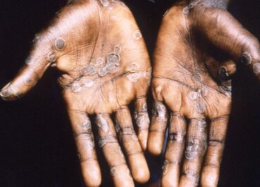 Viruela del mono. EU distribuirá vacunas entre contactos de personas infectadas