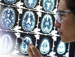 ¿El herpes labial puede causar alzhéimer? Esto dice un nuevo estudio
