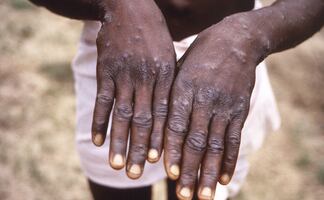 Suecia reporta el primer caso de la variante más peligrosa de la viruela del mono fuera de África