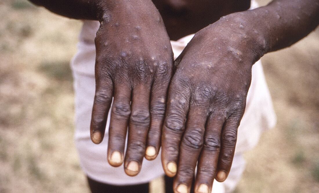 Suecia reporta el primer caso de la variante más peligrosa de la viruela del mono fuera de África. Foto: AP