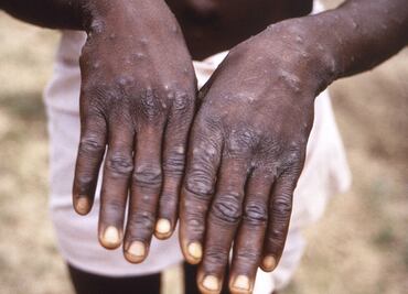 Viruela del mono. OMS sospecha de una “transmisión no detectada a tiempo”